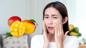 ăn xoài có bị mụn không