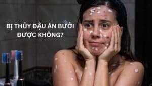 Bị thủy đậu ăn bưởi được không